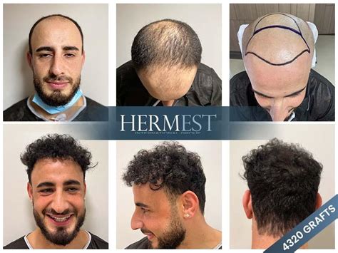 hermest hair transplant yorumlar|best turkey hair transplant package.